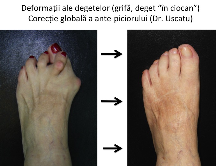 artroza degetului mic pe tratamentul piciorului